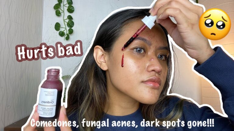 Acne Be Gone: The Ordinary Peeling Solution Before and After Results