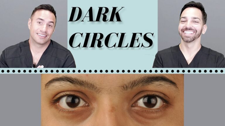 10 Proven Ways to Get Rid of Dark Circles Naturally