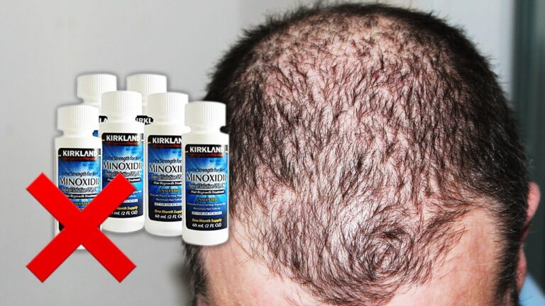 Get Thicker Hair with Minoxidil Drops – The Ultimate Solution for Hair Loss!