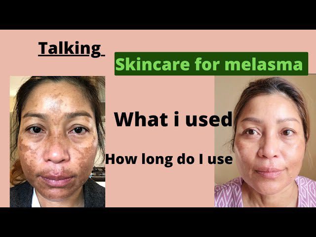 5 Best Melasma Creams to Buy at Boots Store