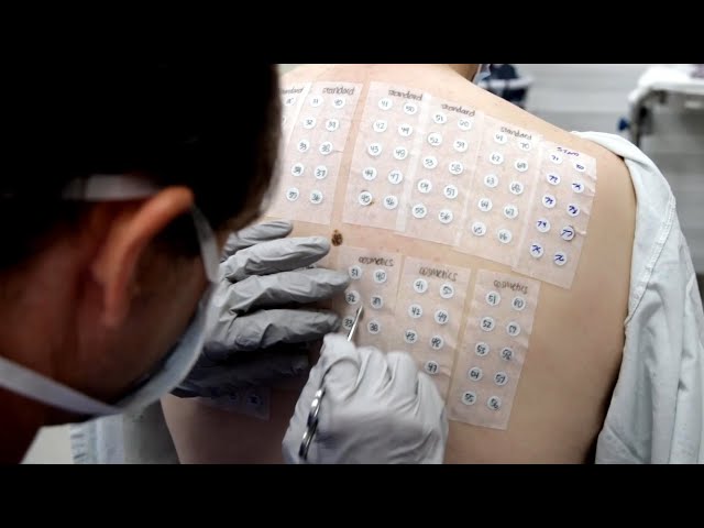 A Comprehensive Guide to Understanding and Managing Patch Test Reactions
