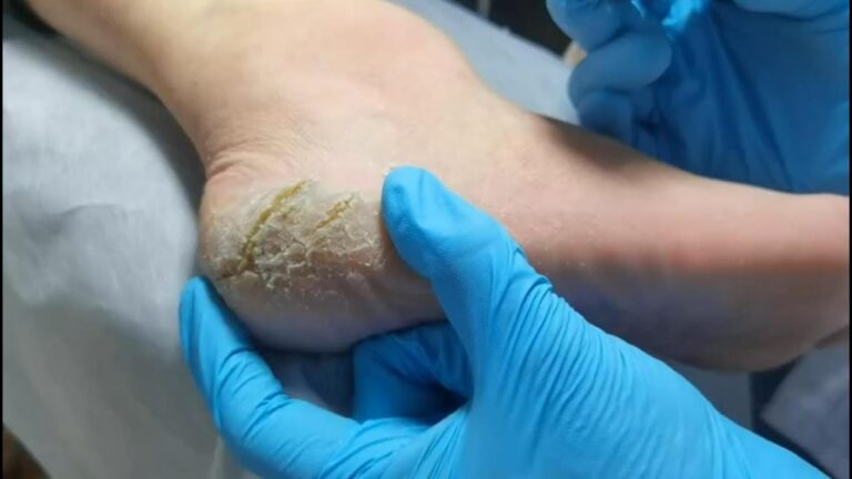 The Ultimate Dead Skin Remover for Feet: Say Goodbye to Calluses and Cracked Heels