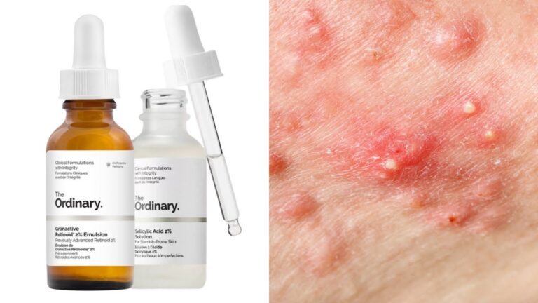 The Ultimate Guide to The Ordinary Acne Treatment for Clearer Skin