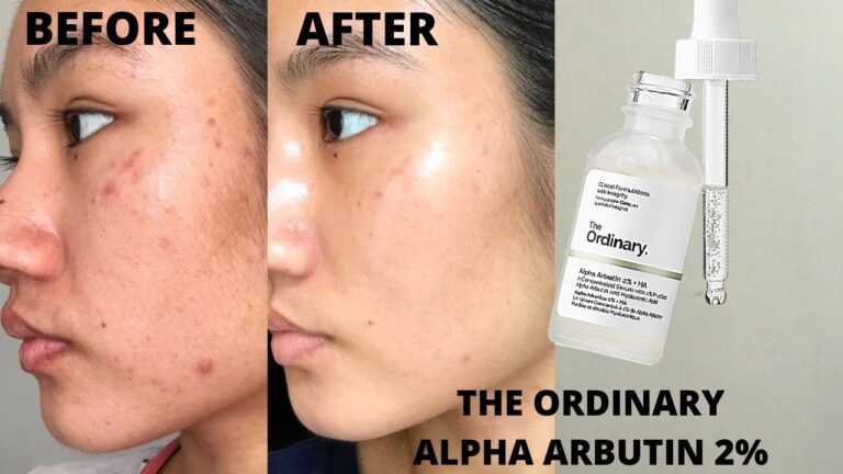 Unveiling the Truth: A Complete Review of The Ordinary Alpha Arbutin