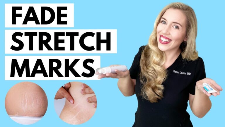 10 Effective Skin Stretch Mark Treatments You Must Try Today!