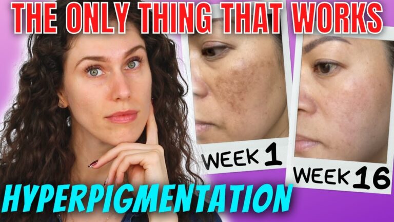 Combatting Hyperpigmentation with the Best Boots: A Comprehensive Guide