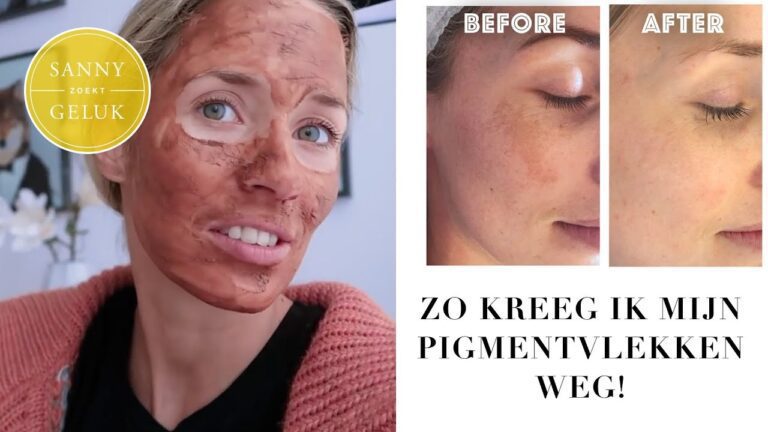 Discover Effective Ways to Treat and Prevent Melasma
