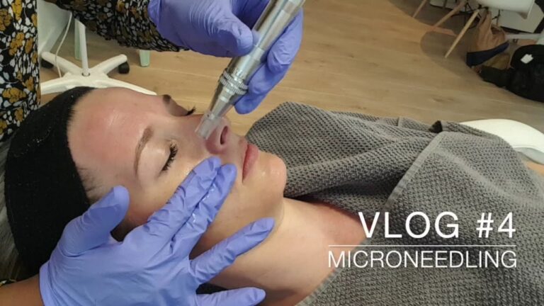 Get flawless skin with microneedling – The ultimate guide