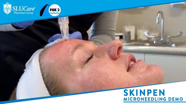 Revitalize Your Skin with Microneedling Treatment: Benefits, Procedure, and Results