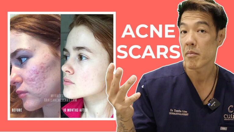 Say Goodbye to Skin Acne Scars: Effective Treatment Options